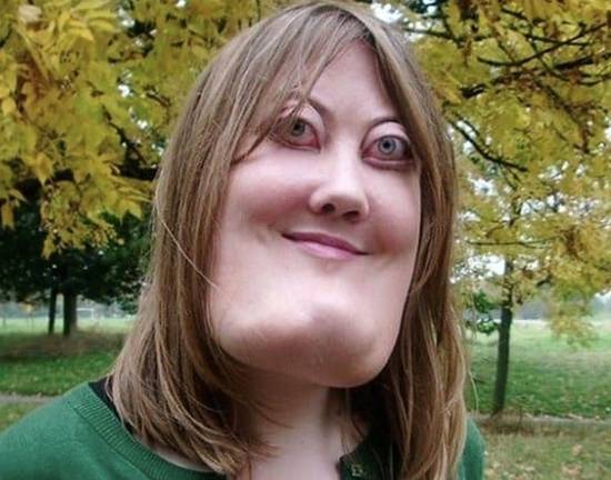 不活在嘲笑中 用坚韧笑对世界：她与天使面容的非凡人生‌